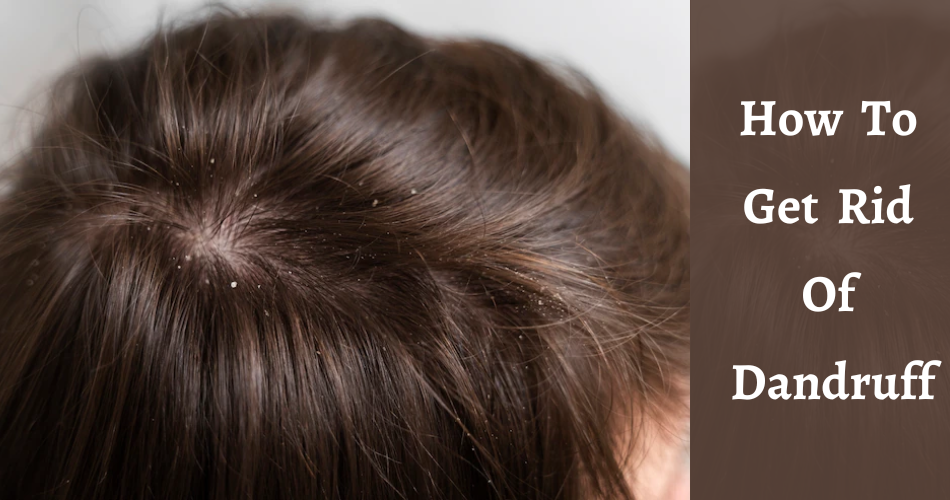How to Get rid of dandruff naturally